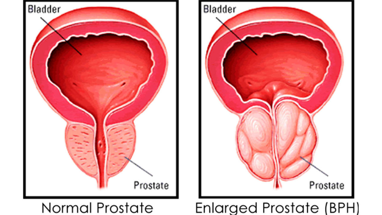 What Happens If BPH Is Not Treated