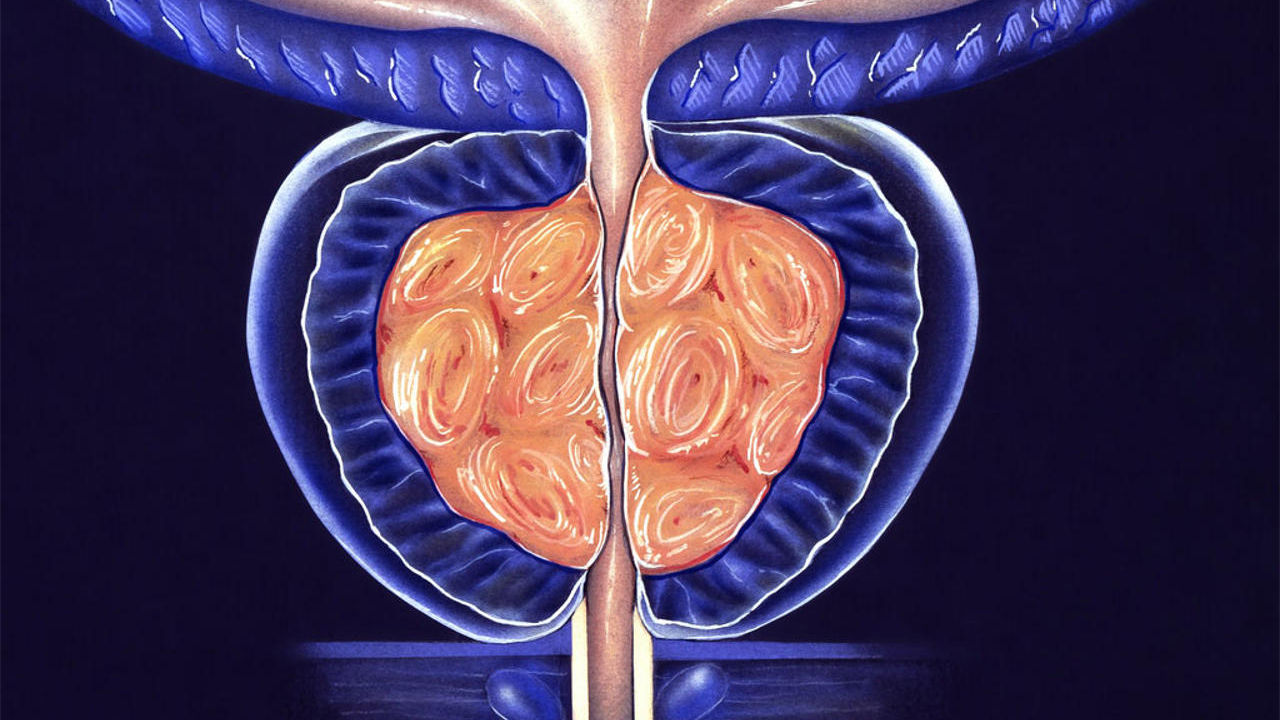 what is the latest treatment for enlarged prostate 2023